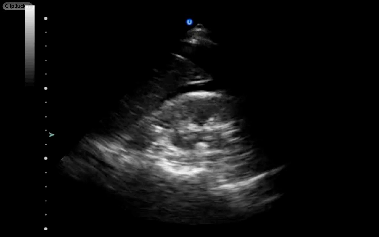 01_ScanLUQFFsplenorenal.jpg