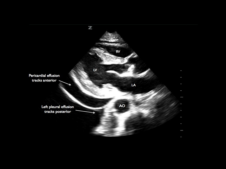 02_PericardialEffusionLabelled.png 700