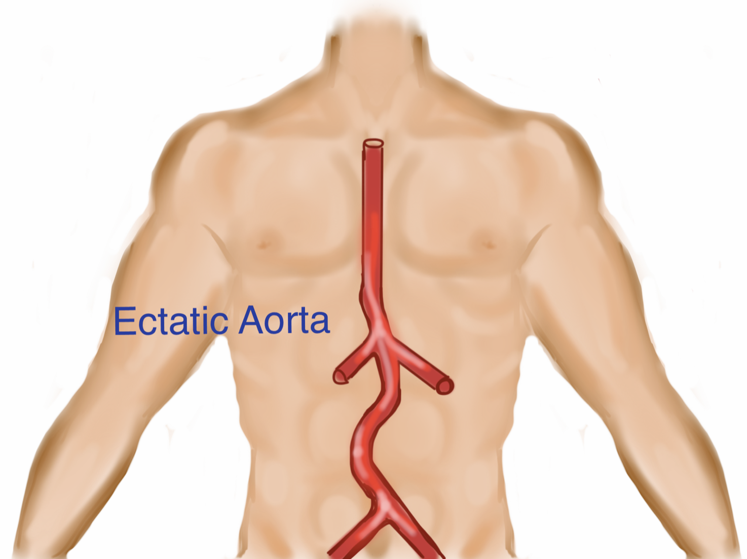 03_AnatAortaEctaticCartoon.png