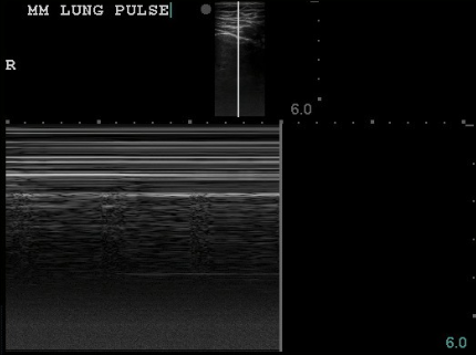 05_ScanLungMModeLungPulse.png 700