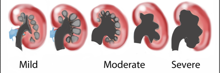 06_AnatRenalHydronephrosisCartoon.png